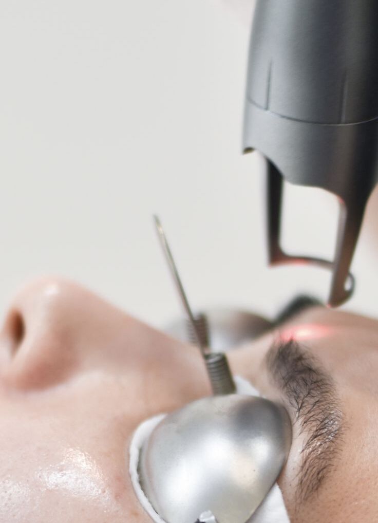 Remocion Laser de Cejas